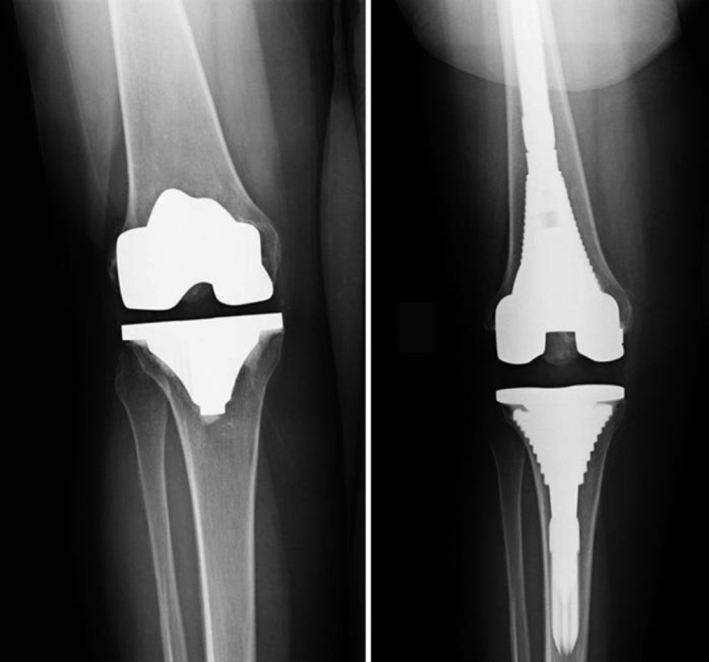 revision-total-knee-replacement-orthoinfo-aaos