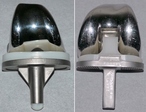 Knee replacement implants