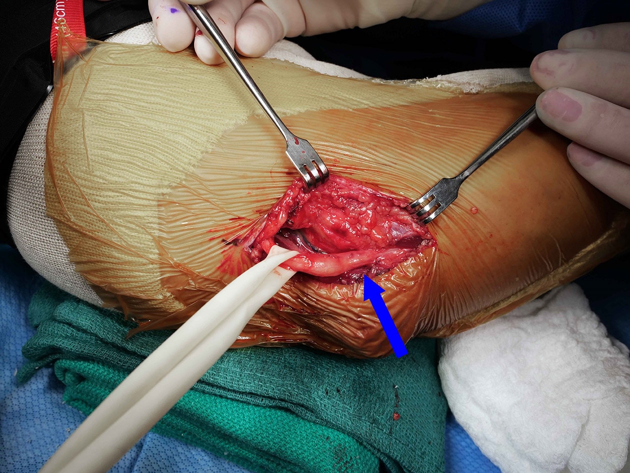 cubital tunnel release surgery