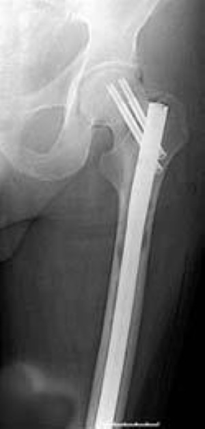 intramedullary rod in femur for MBD