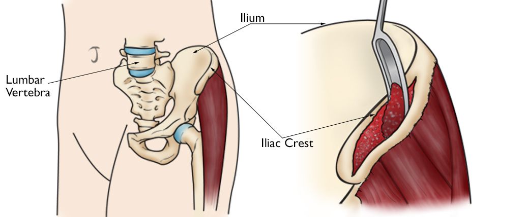 Hip anatomy, showing the iliac crest of the hip
