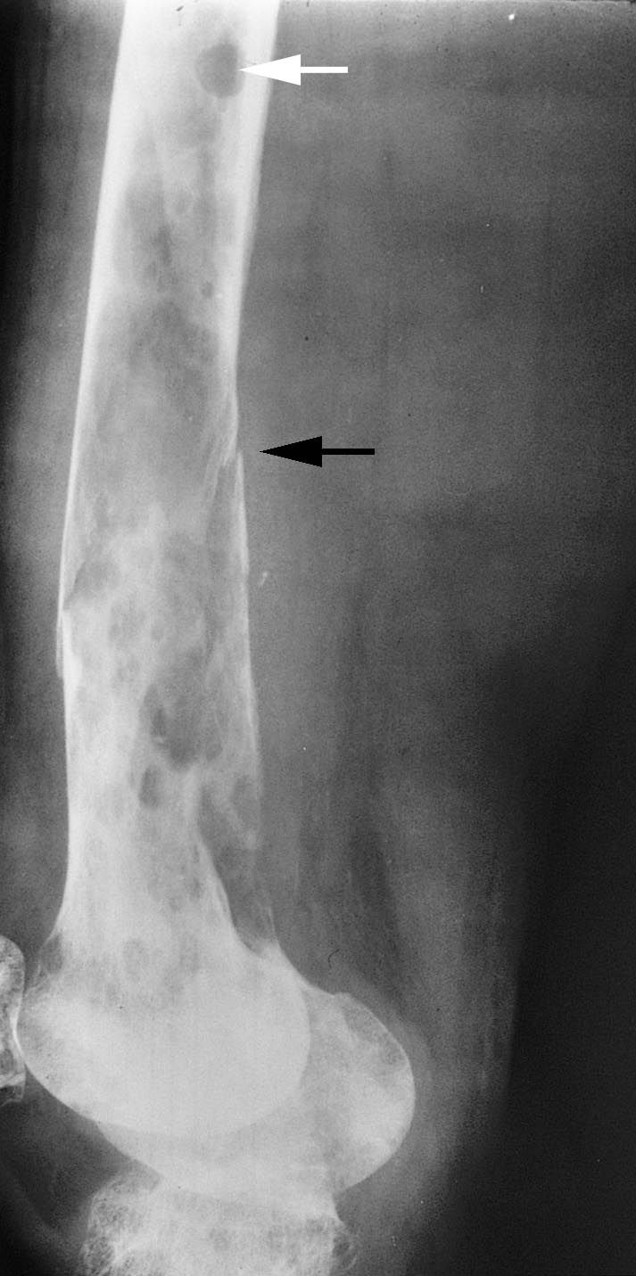X-rays of multiple myeloma and a pathologic fracture
