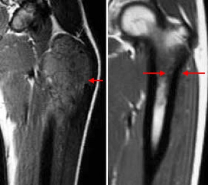 MRI of Ewing's sarcoma before and after chemotherapy
