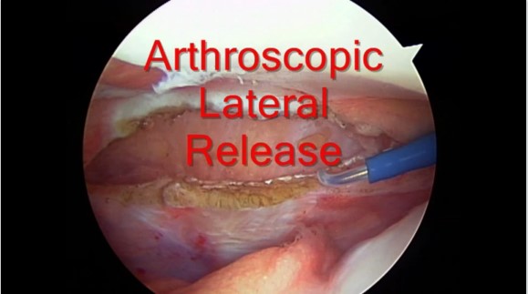 arthroscopic lateral release