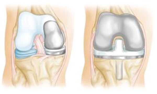 uni knee replacement implant and total knee replacement implant