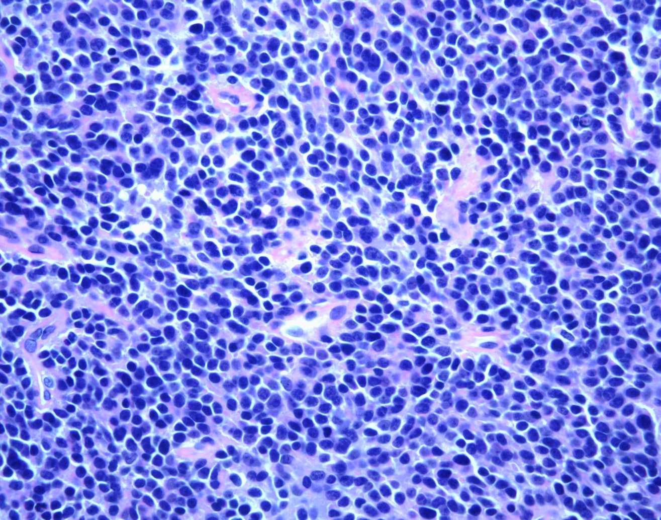 Microscopic view of Ewing's sarcoma