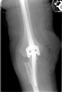 elbow joint replacement