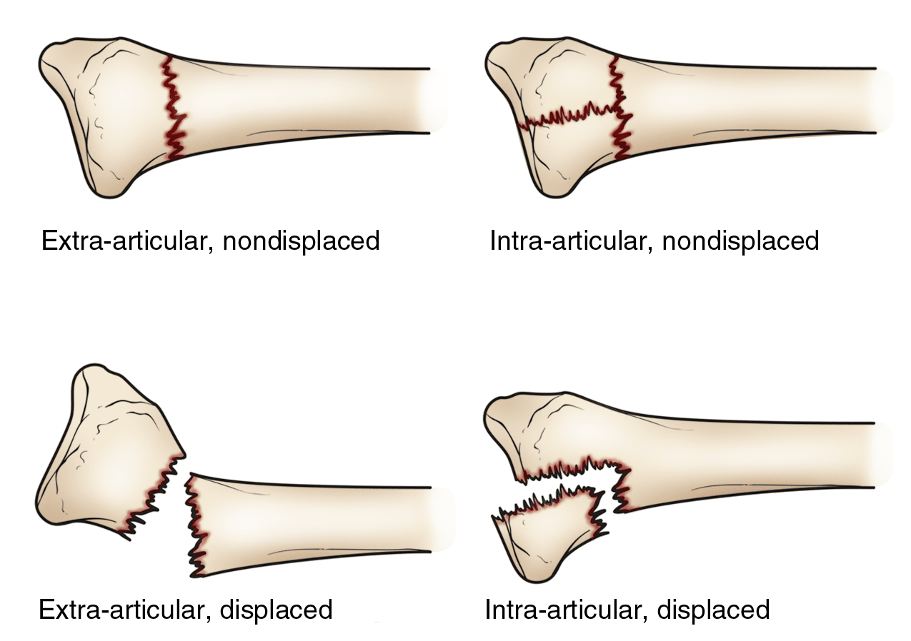 types of distal radius fractures