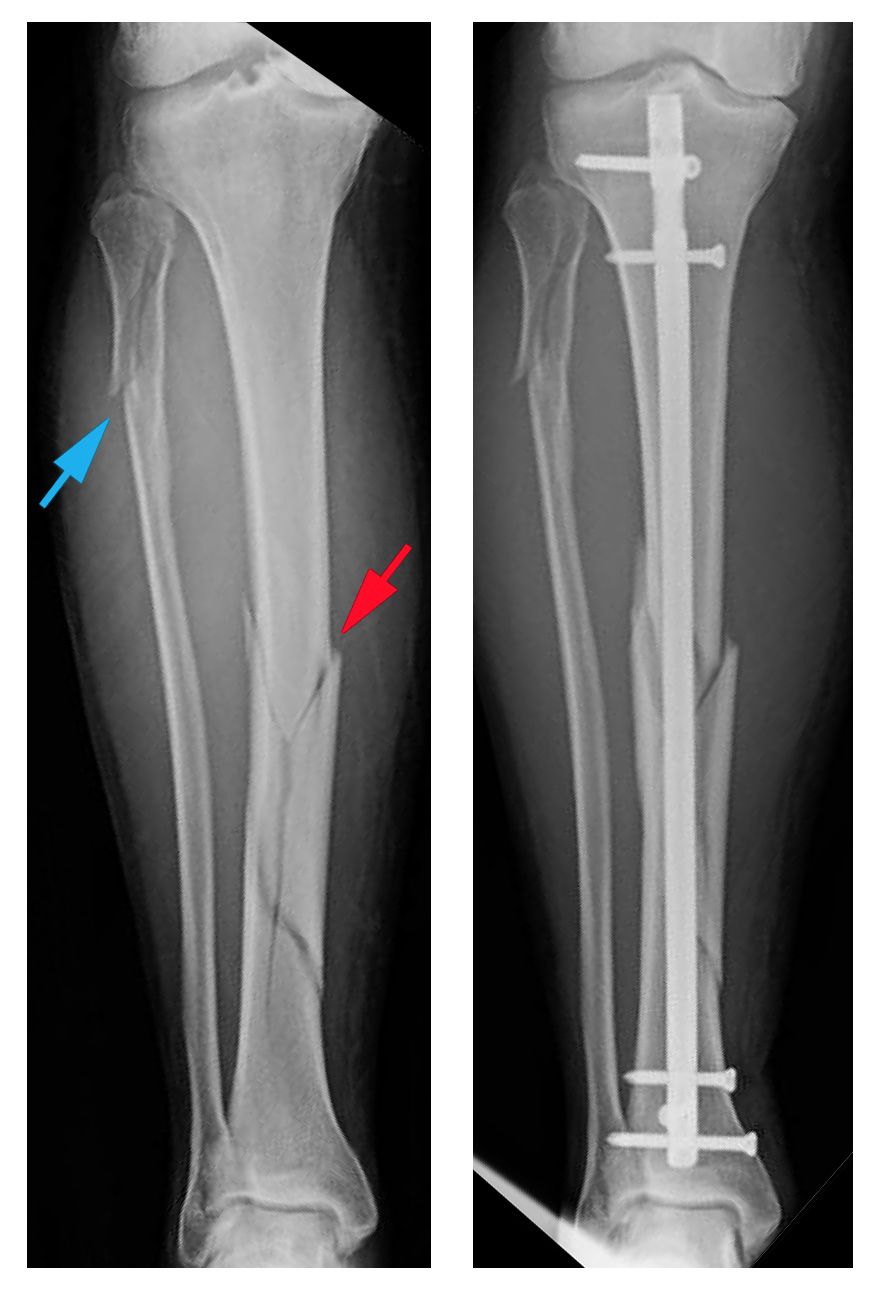 X-rays of tibial shaft fracture and intramedullary nailing