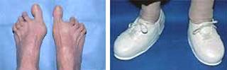 Special shoes for patients with rheumatoid arthritis of the foot