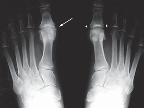 X-ray of Feet With Hallux Rigidus