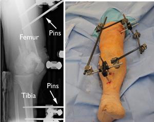 External fixation of distal femur fracture