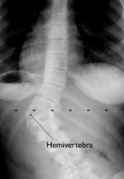congenital scoliosis curve caused by hemivertebra