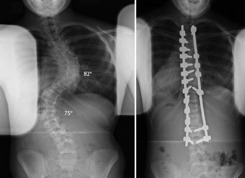 x-rays of scoliosis curves and fusion