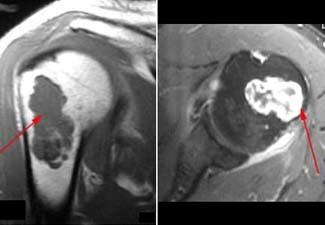 MRI scans of enchondroma in upper arm
