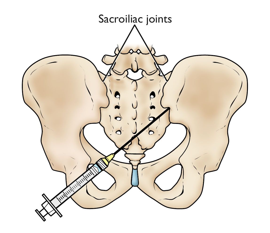 Sacroiliac joint injection in the pelvis