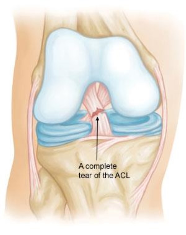 complete tear of the ACL