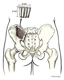 bone graft from pelvis
