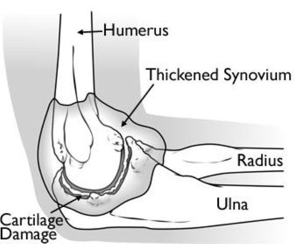 Total Elbow Replacement - OrthoInfo - AAOS