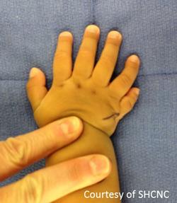 polydactyly