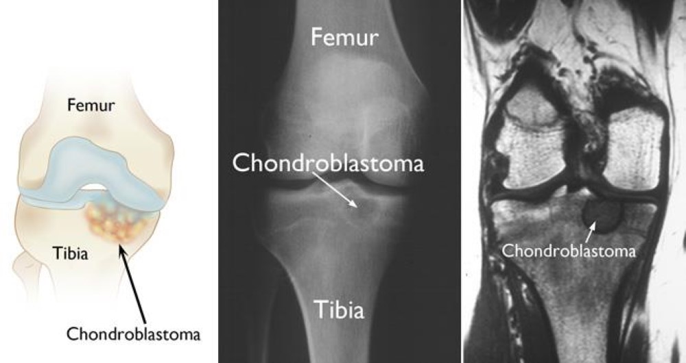 Illustration (left), x-ray (center), and MRI scan (right) all show a chondroblastoma at the top of the (tibia) shinbone. This is a common location for the tumors to occur. 