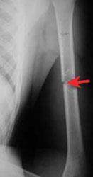 Humerus (upper arm) tumor and pathologic fracture