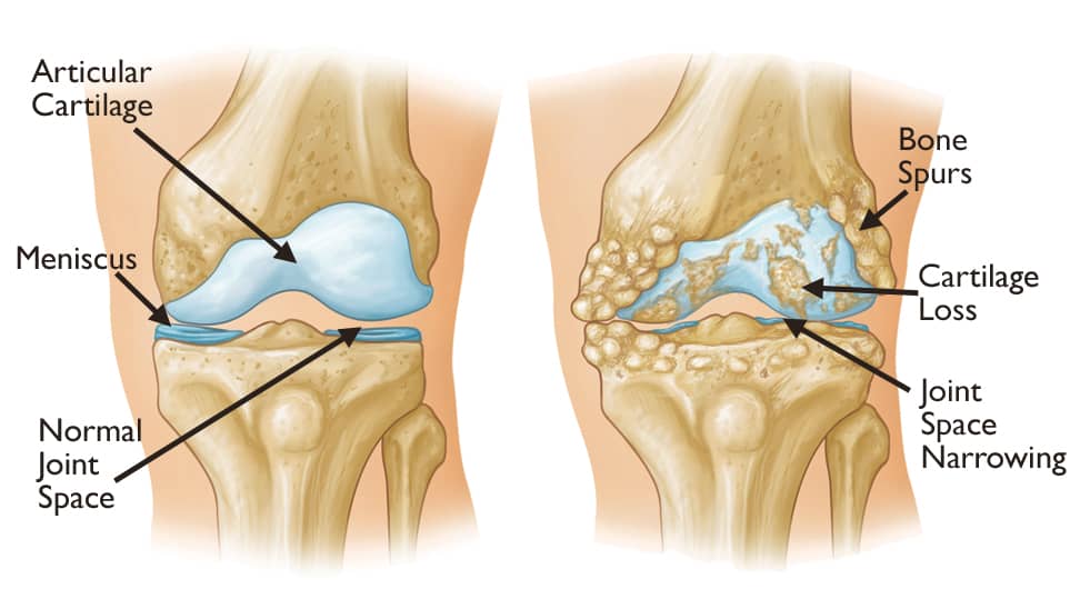 Normal and Arthritic Knee