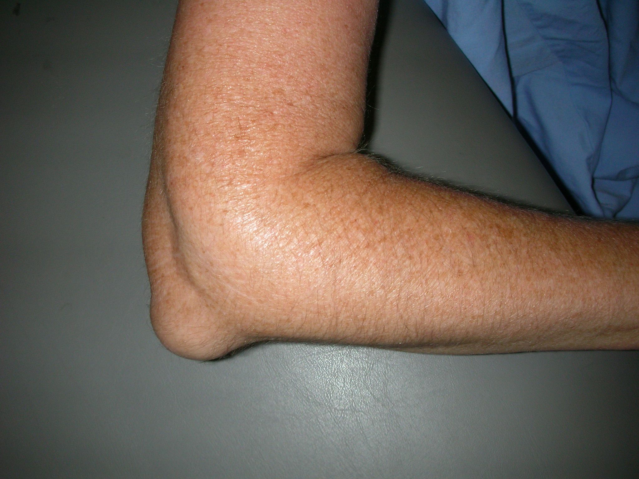 Swelling from elbow bursitis