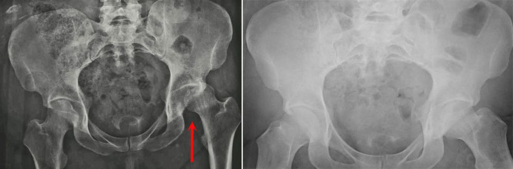 X-rays of a dislocated hip before and after reduction
