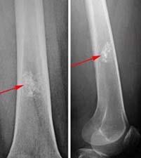 X-rays of enchondroma in the femur