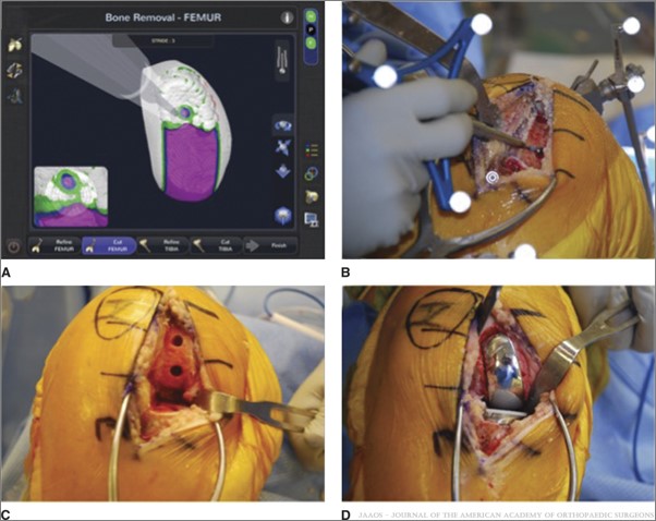 Robotic-Assisted Unicompartmental Knee Replacement