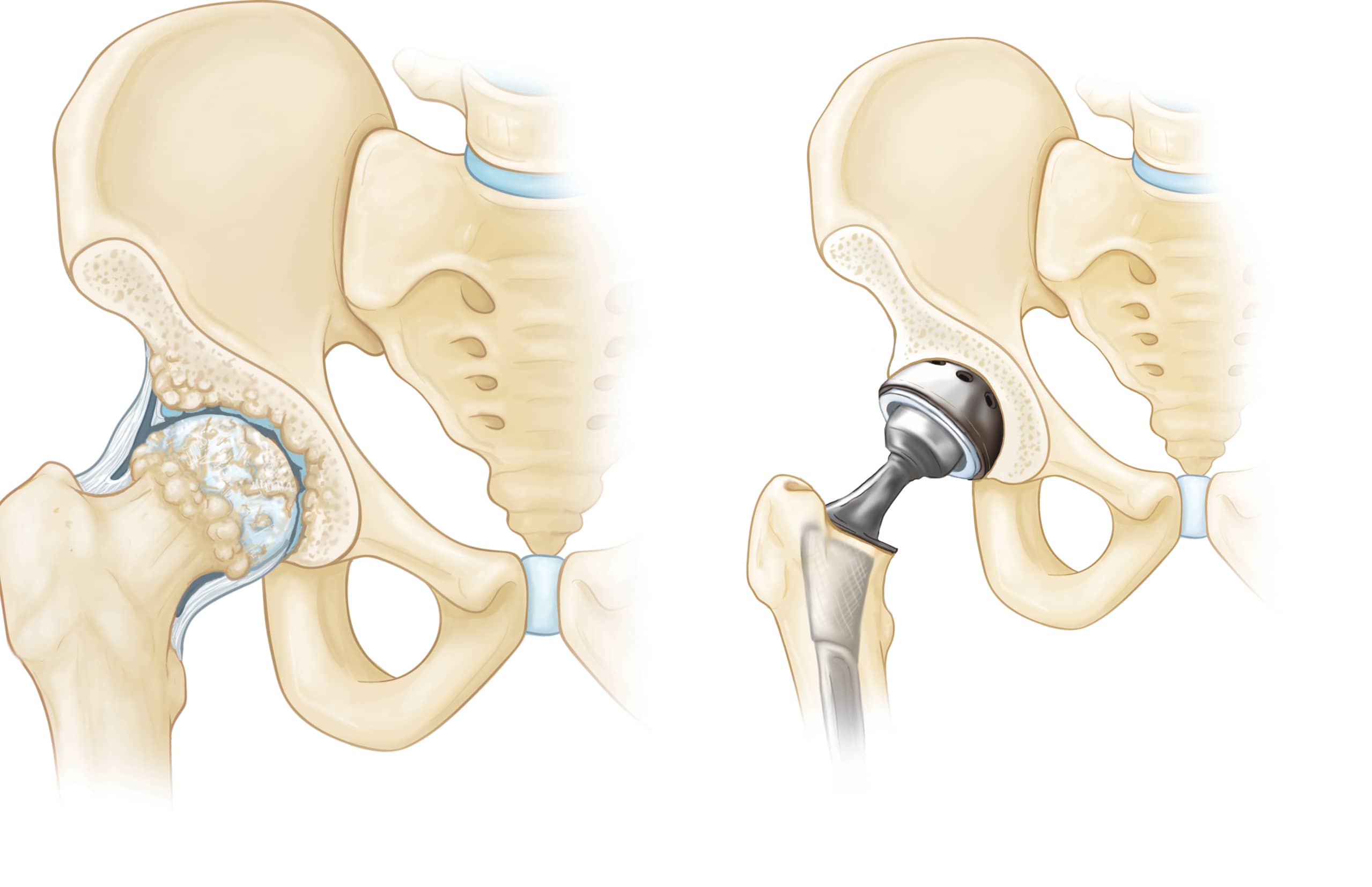 Hip with Osteoarthritis and Hip After Hip Replacement