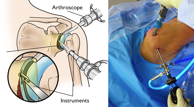 illustration and photo of shoulder arthroscopy