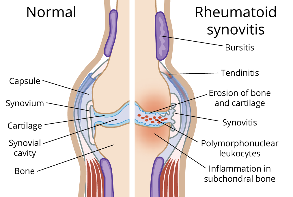 Diagram Showing Healthy Knee Joint and Knee joint with Rheumatoid Arthritis