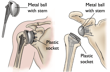 Illustrations of total shoulder replacement and reverse total shoulder replacement