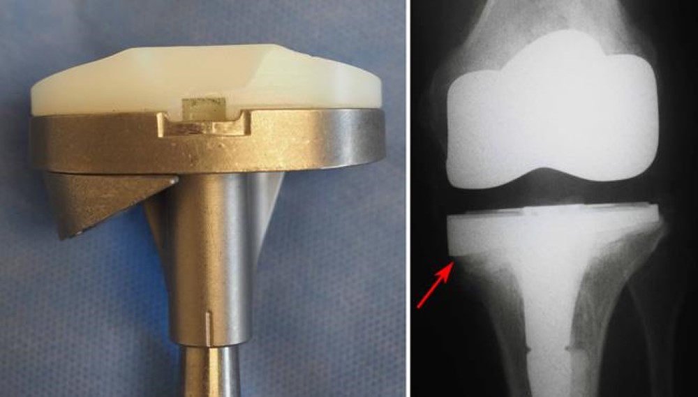 additional block added to knee implant