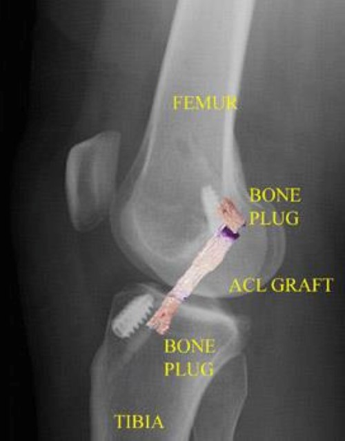 post-operative x-ray of ACL reconstruction