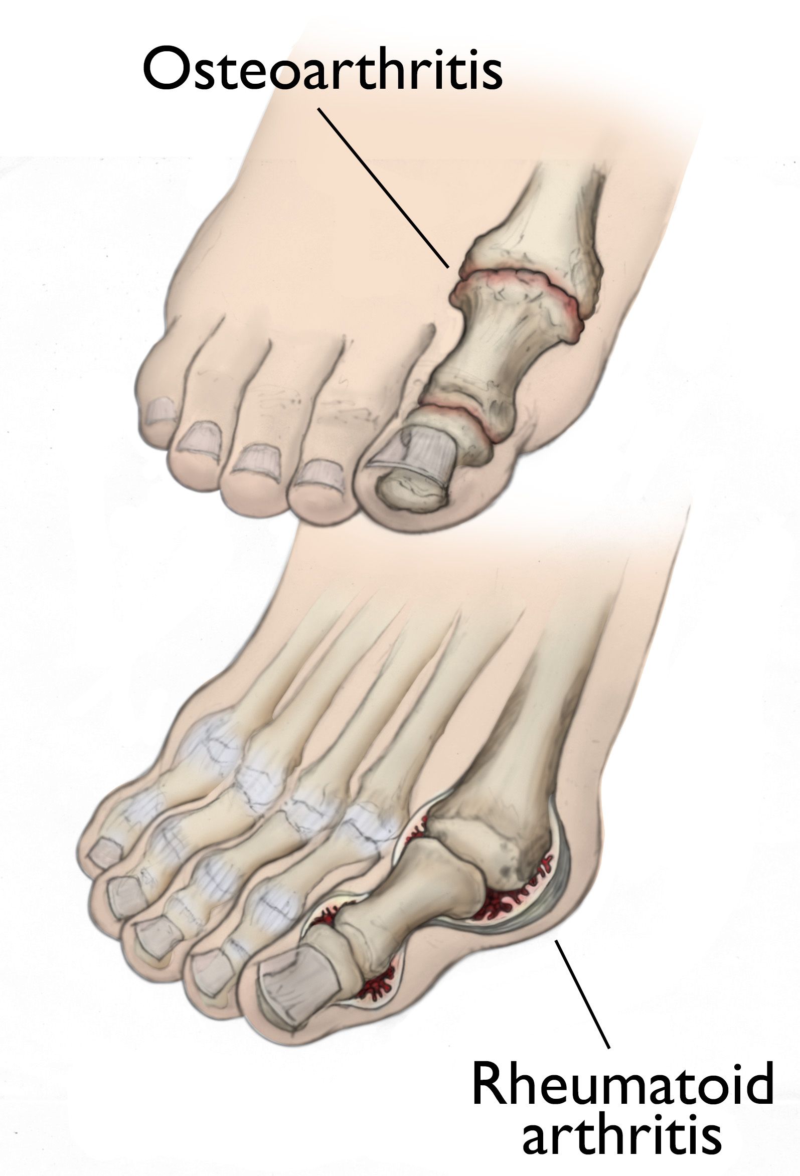 illustrations of osteoarthritis and rheumatoid arthritis of the big toe