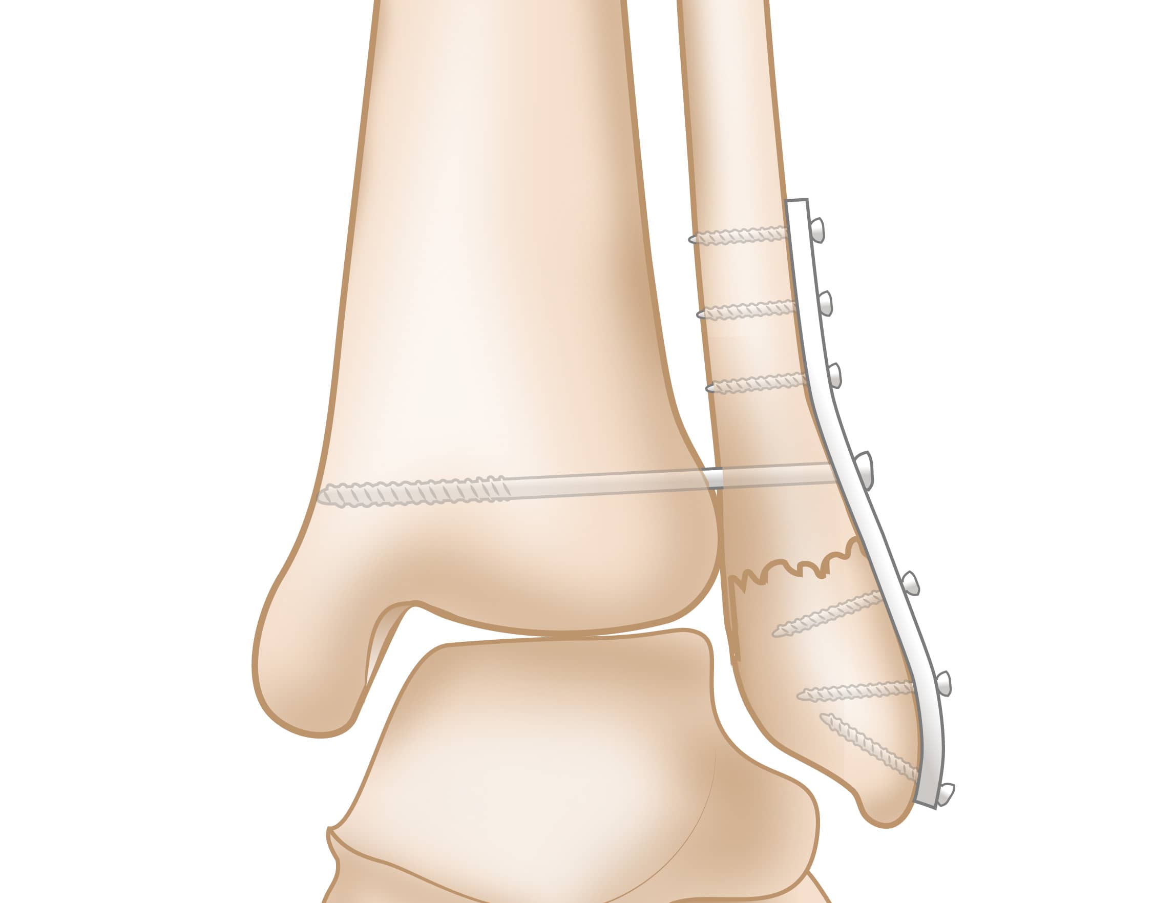 Surgical Repair of a Syndesmosis Injury and Lateral Malleolus Fracture