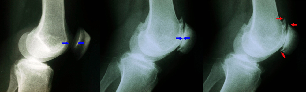 X-rays of healthy knee and knee with patellofemoral arthritis