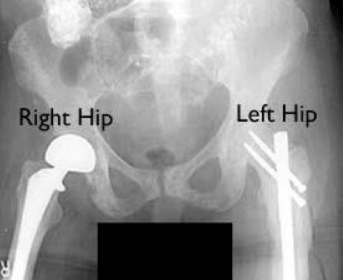 two types of hip stabilization for metastatic bone disease