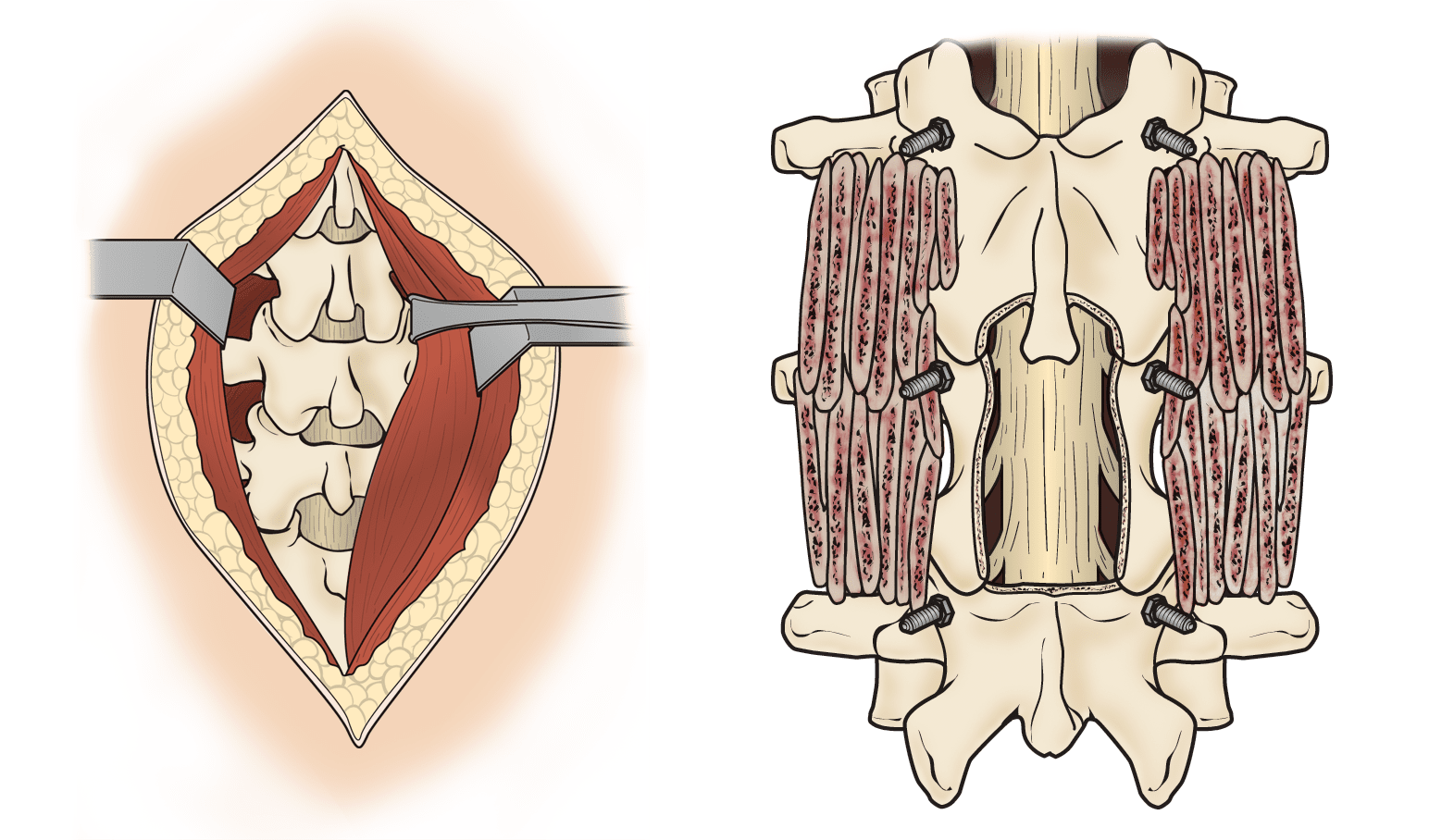 Illustration of a laminectomy procedure