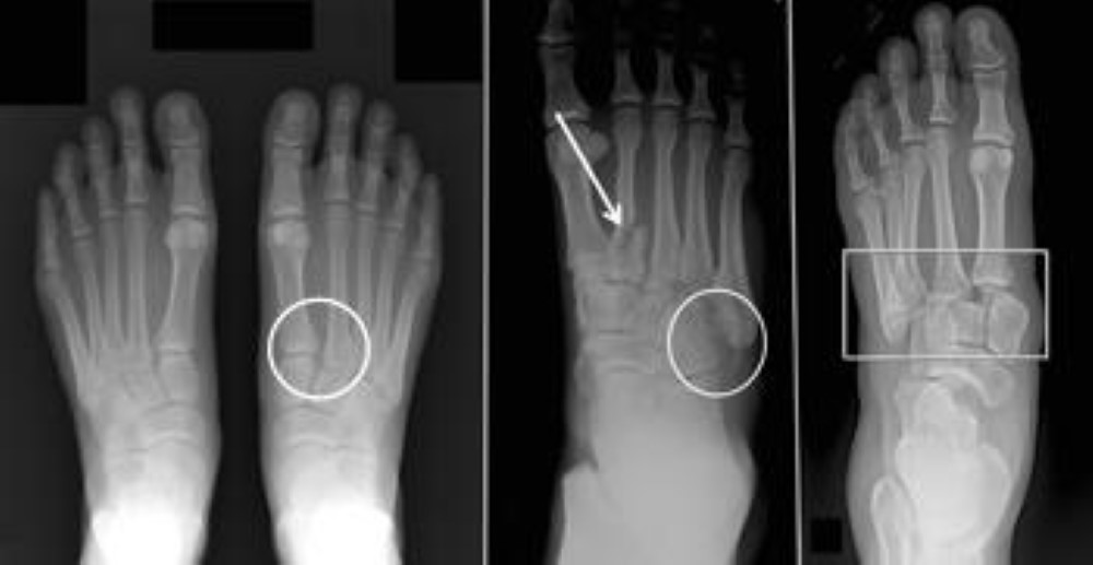 Different types of Lisfranc injuries