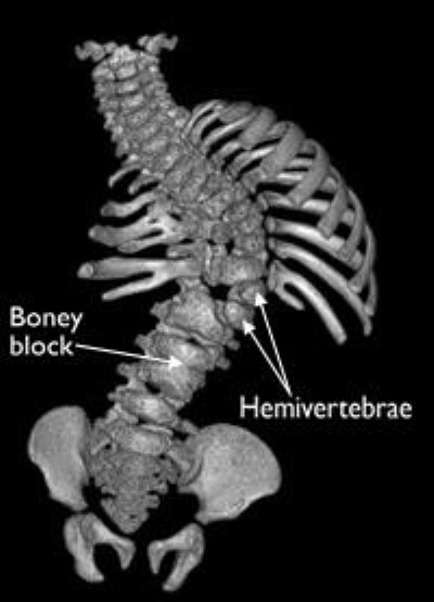 CT scan shows hemivertebrae, as well as a fused, boney block