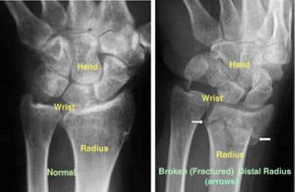 x-ray of distal radius fracture
