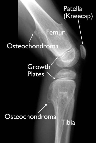 Multiple osteochondromas