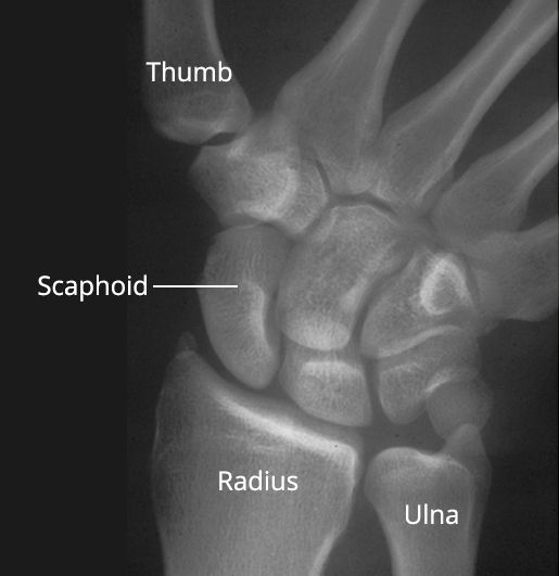 Normal wrist anatomy including the scaphoid bone