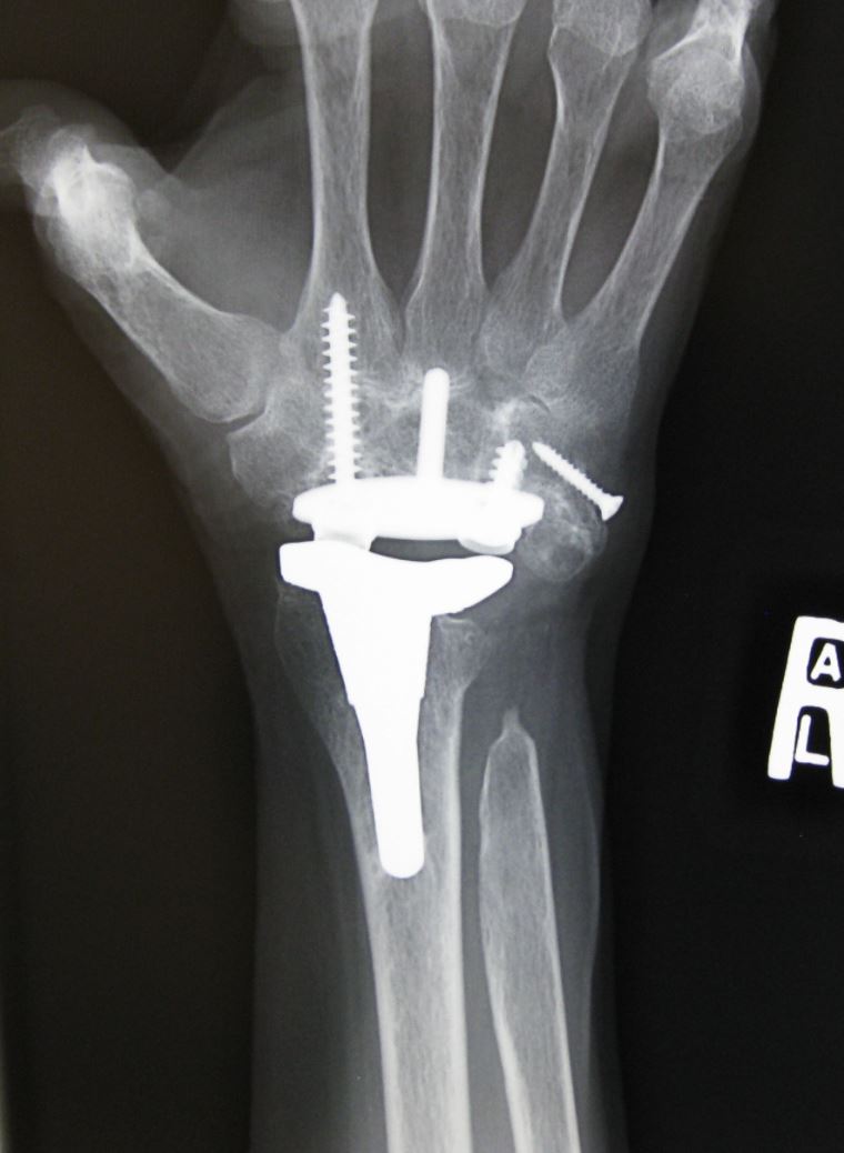 X-ray of Wrist After Joint Replacement