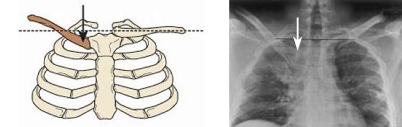 illustration and x-ray of posterior sternoclavicular dislocation