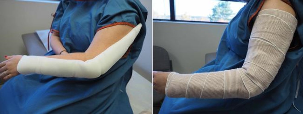 Photo of patient wearing a splint for an olecranon fracture
